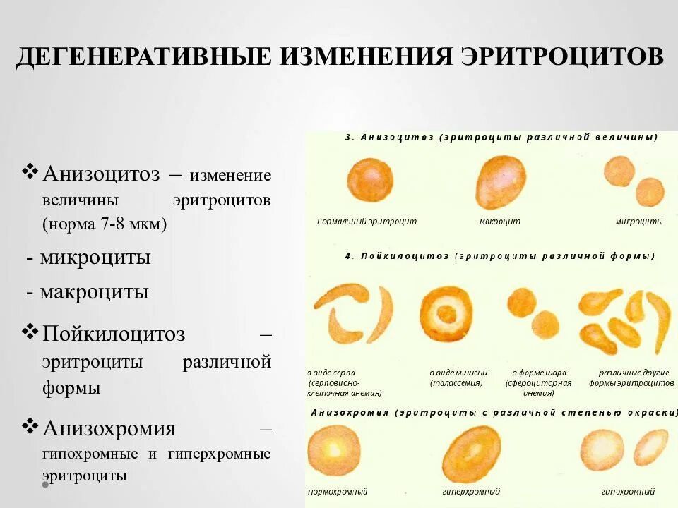 Пойкилоцитоз анемия. Анизоцитоз микроцитоз. Изменение формы эритроцитов (пойкилоцитоз). Патологические формы эритроцитов анизохромия. Патологические формы эритроцитов пойкилоцитоз.