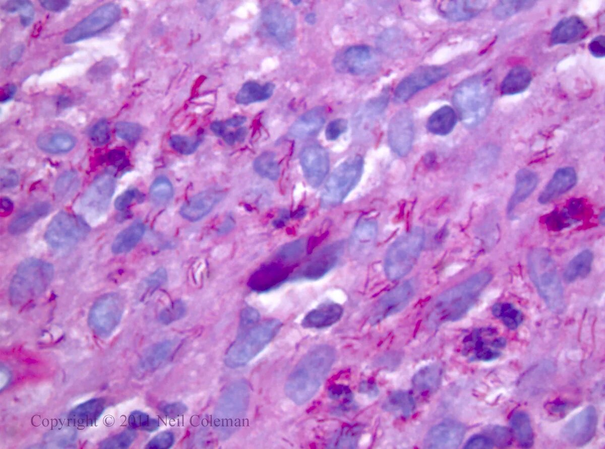 Mycobacterium kansasii гистология. Морфология нетуберкулезных микобактерий. Mycobacterium avium микробиология. Mycobacterium kansasii морфология. Нетуберкулезный микобактериоз