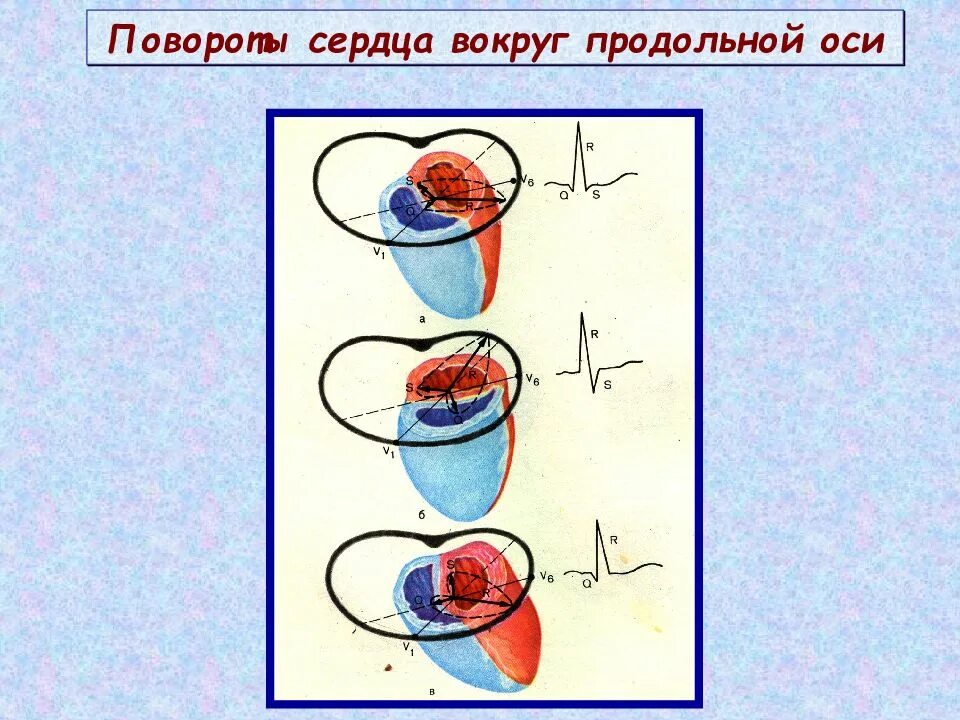 Повороты сердца вокруг оси на экг. Поворот сердца верхушкой назад что это значит. Поворот сердца верхушкой кпереди на экг. Повороты сердца на экг. Поворот сердца вокруг поперечной оси.