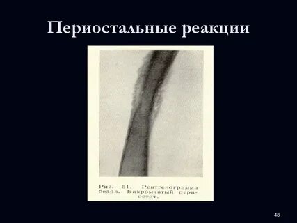 Периостальная реакция