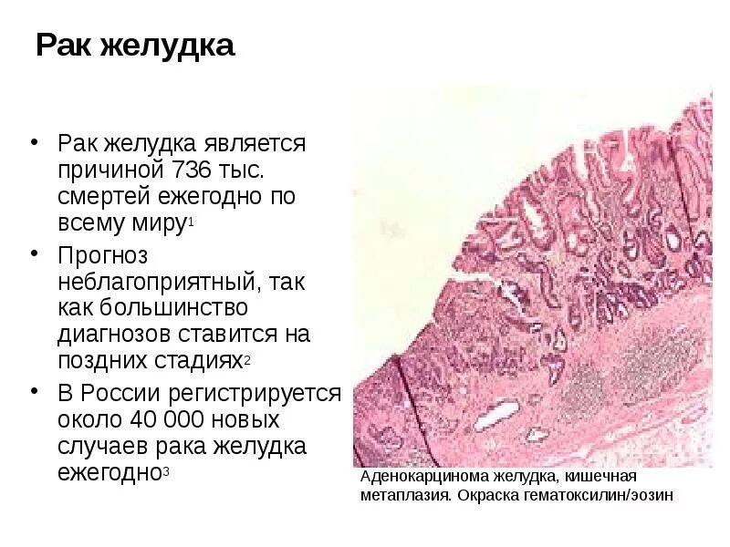 Гастроскопия