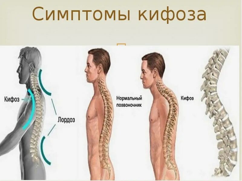 Сколиоз кифоз грудного отдела. Лордоз грудного отдела кифоз поясничного. Искривление грудного отдела позвоночника кифоз. Кифоз лордоз грудного отдела позвоночника.