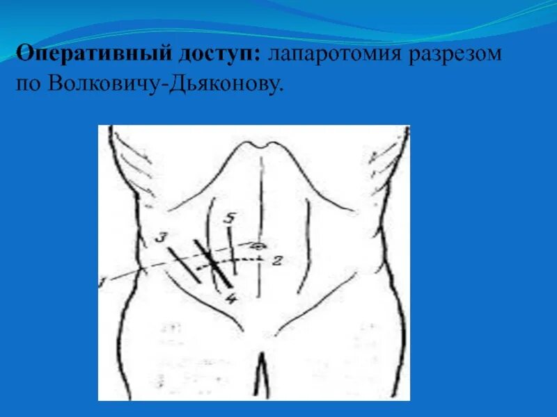 Какое лапаротомия. Разрез Мак Бурнея Волковича Дьяконова. Лапаротомия доступом Волковича-Дьяконова. Аппендэктомия разрез по Волковичу Дьяконову. Лапаротомия по Волковичу Дьяконову.