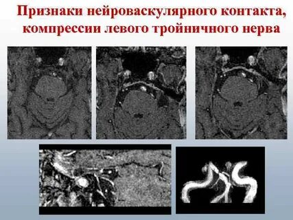 Нейроваскулярный конфликт нерва