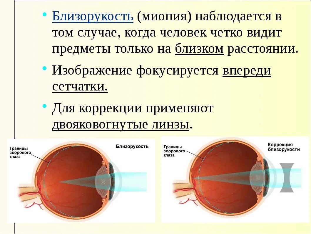 Миопия. Заболевание органов зрения миопия. близорукость по биологии 8 класс. зрение близорукость. пия мия.