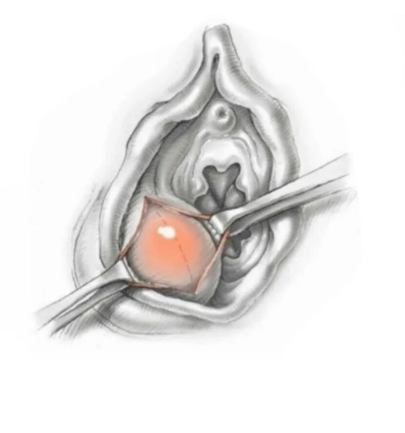 Катетер бартолиновой железы. Воспаление бартолиновой железы. Кистабартоливойжелезы. Киста бартолиновой железы. Вскрытие абсцесса бартолиновой железы.