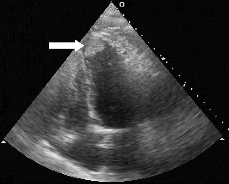 Тромб в правом предсердии на ЭХОКГ. Тромб в левом желудочке сердца. Аномальная хорда левого желудочка на ЭХОКГ. Сердечный тромбоз