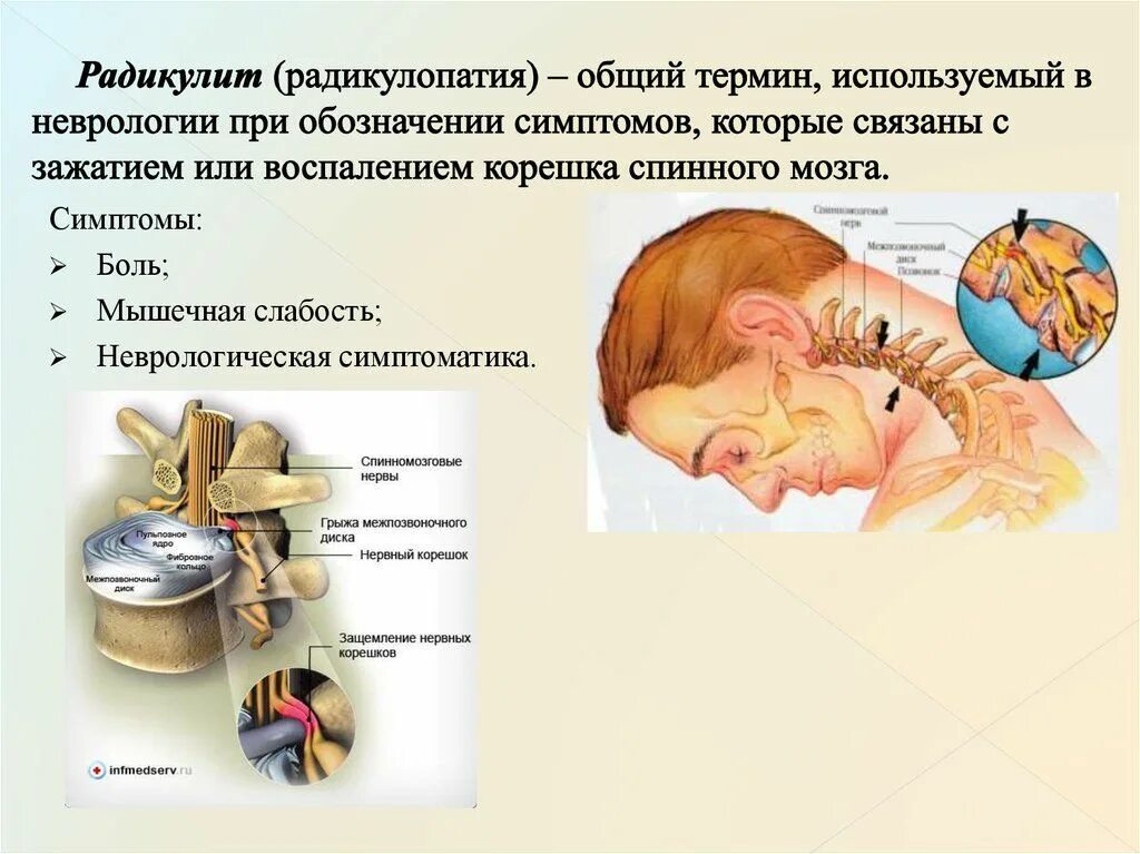 Синдром радикулопатии. Радикулопатия. Симптомы радикулопатии. Спондилогенная радикулопатия. Радикулопатии неврология.