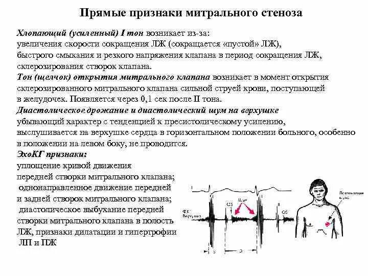 Эхо кг при митральном стенозе заключение. Клинические признаки митрального стеноза. Аускультативный синдром при митральном стенозе. Митральная недостаточность клиника. Митральный стеноз признаки