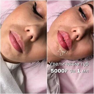 Корейский филлер для увеличения губ