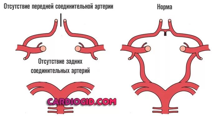 Соединительные артерии Виллизиева круга. Сосуды Виллизиева круга анатомия кт. Виллизиев круг задние соединительные артерии. Аномалии развития Виллизиева круга мрт.