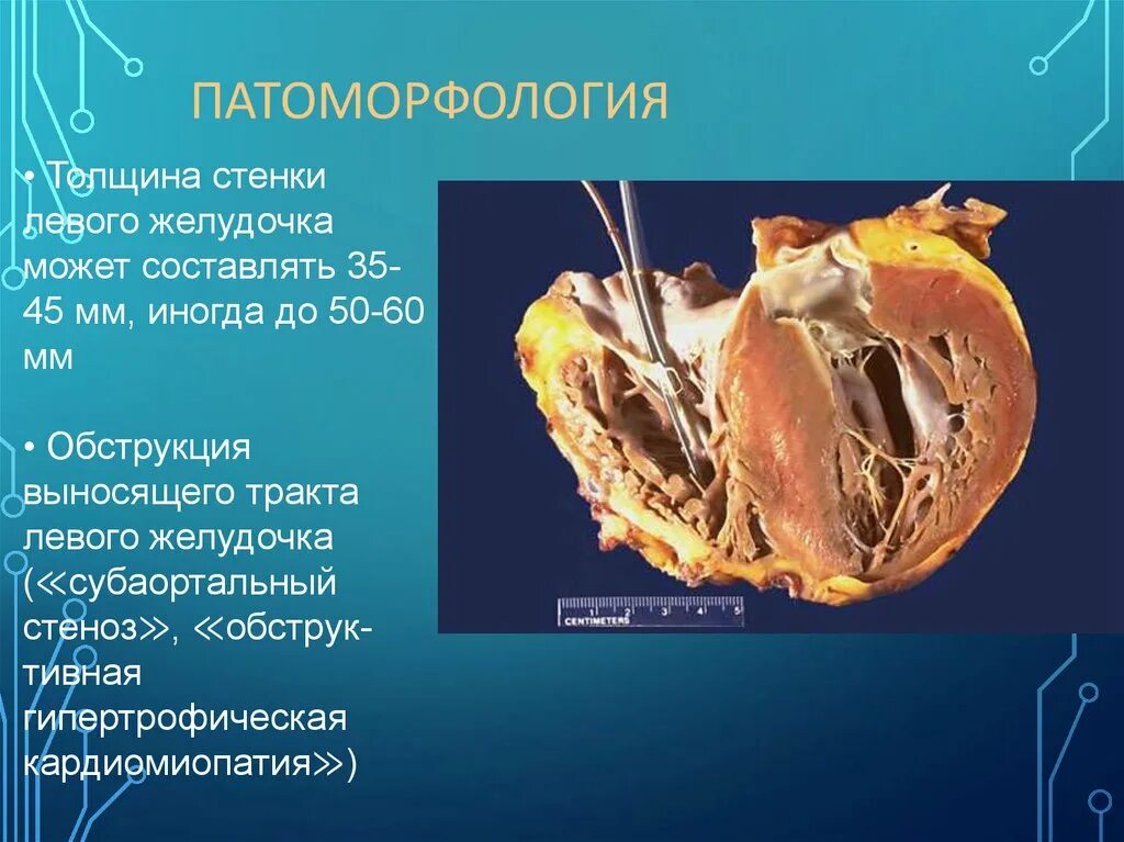 Изменение передней стенки левого желудочка. Обструкция левого желудочка. Обструкция выносящего тракта левого желудочка. Степени обструкции выносящего тракта левого желудочка. Обструкция выходного тракта левого желудочка.