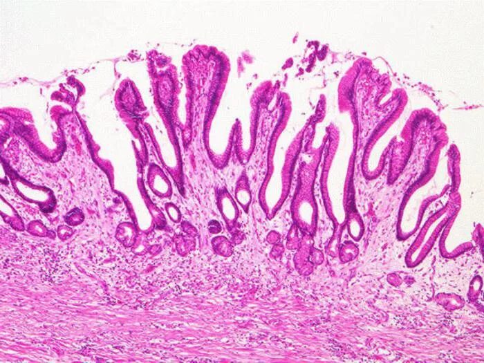 Эритематозная гастропатия гистология. Застойная дуоденопатия. Эритематозно геморрагическая гастропатия. Диффузия эритематозная гастропатия. Слизистая атрофична