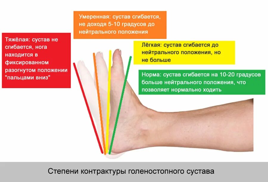 Посттравматический контрактура сустава. Контрактура сустава ноги. Комбинированная контрактура голеностопного сустава. Сгибательная контрактура голеностопного сустава. Разгибательная контрактура коленного сустава.