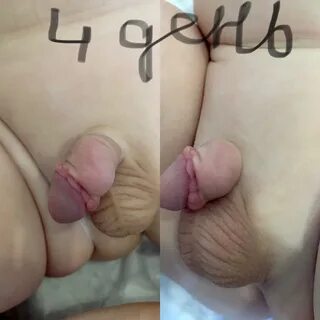 Уплотнение появилось через месяц после обрезания.