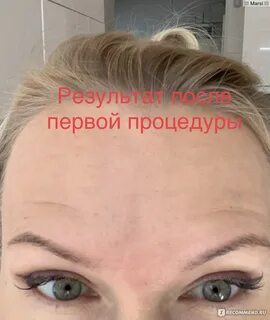 Брови после диспорта