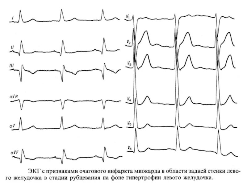 Очаговые изменения левого желудочка. Инфаркт миокарда нижней стенки левого желудочка на ЭКГ. ЭКГ острый инфаркт миокарда нижней стенки левого желудочка. Острый инфаркт миокарда задней стенки левого желудочка ЭКГ. Инфаркт миокарда задней стенки левого желудочка на ЭКГ.