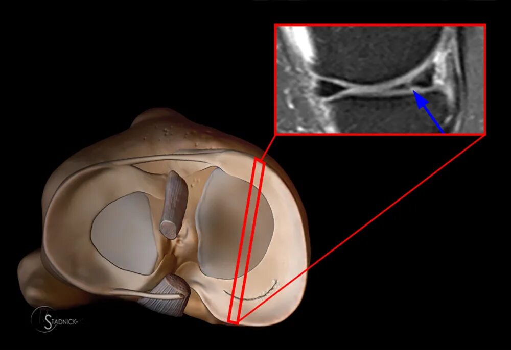 Разрыв медиальной. Хондропластика коленного сустава. Мрт разрыв заднего рога мениска. Повреждение мениска коленного сустава мрт. Продольный разрыв мениска мрт.