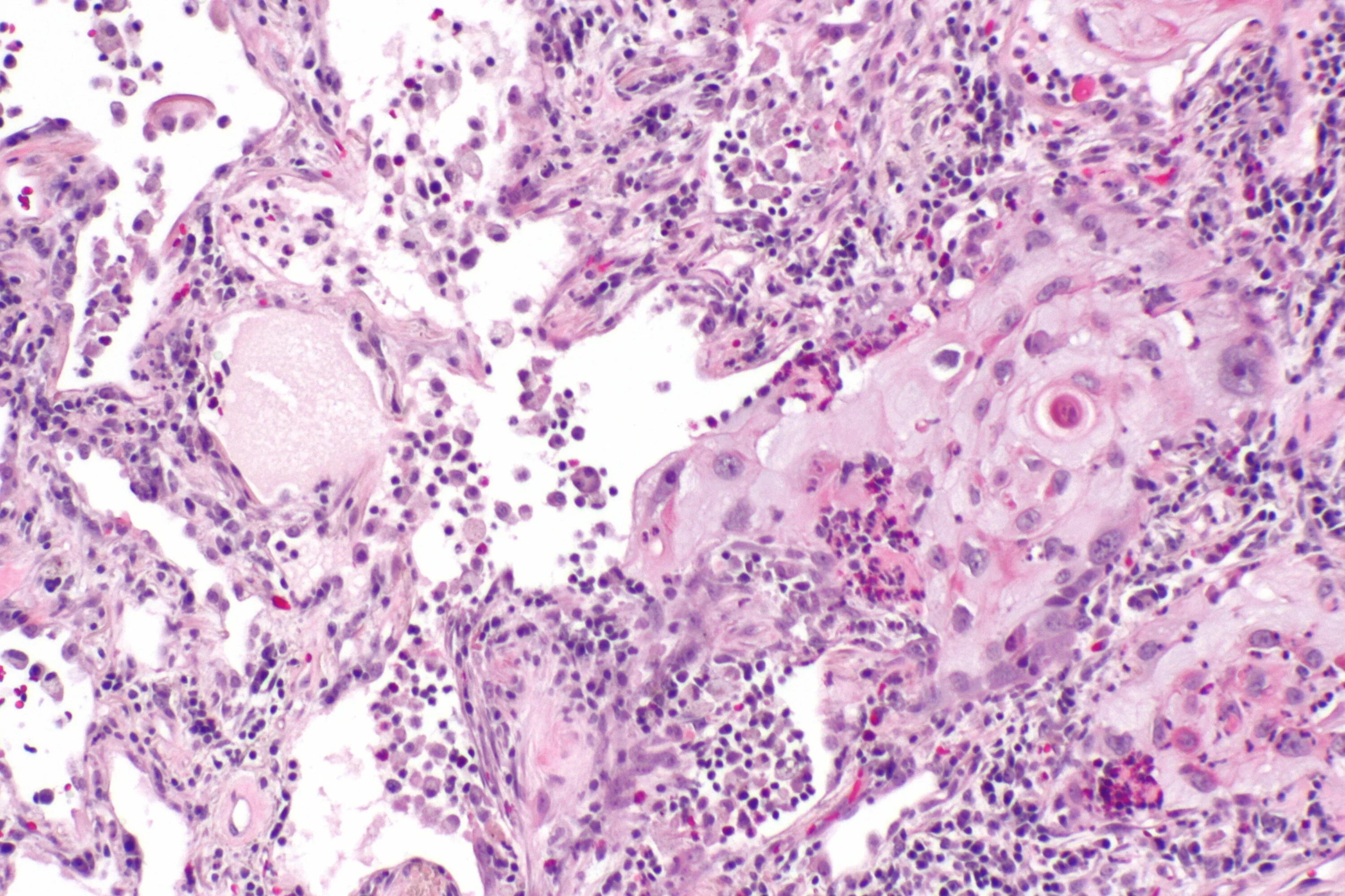 Squamous Cell carcinoma гистология. Плоскоклеточный неороговевающий. Карцинома легкого гистология. Плоскоклеточная карцинома легкого гистология. Низкодифференцированный плоскоклеточный рак