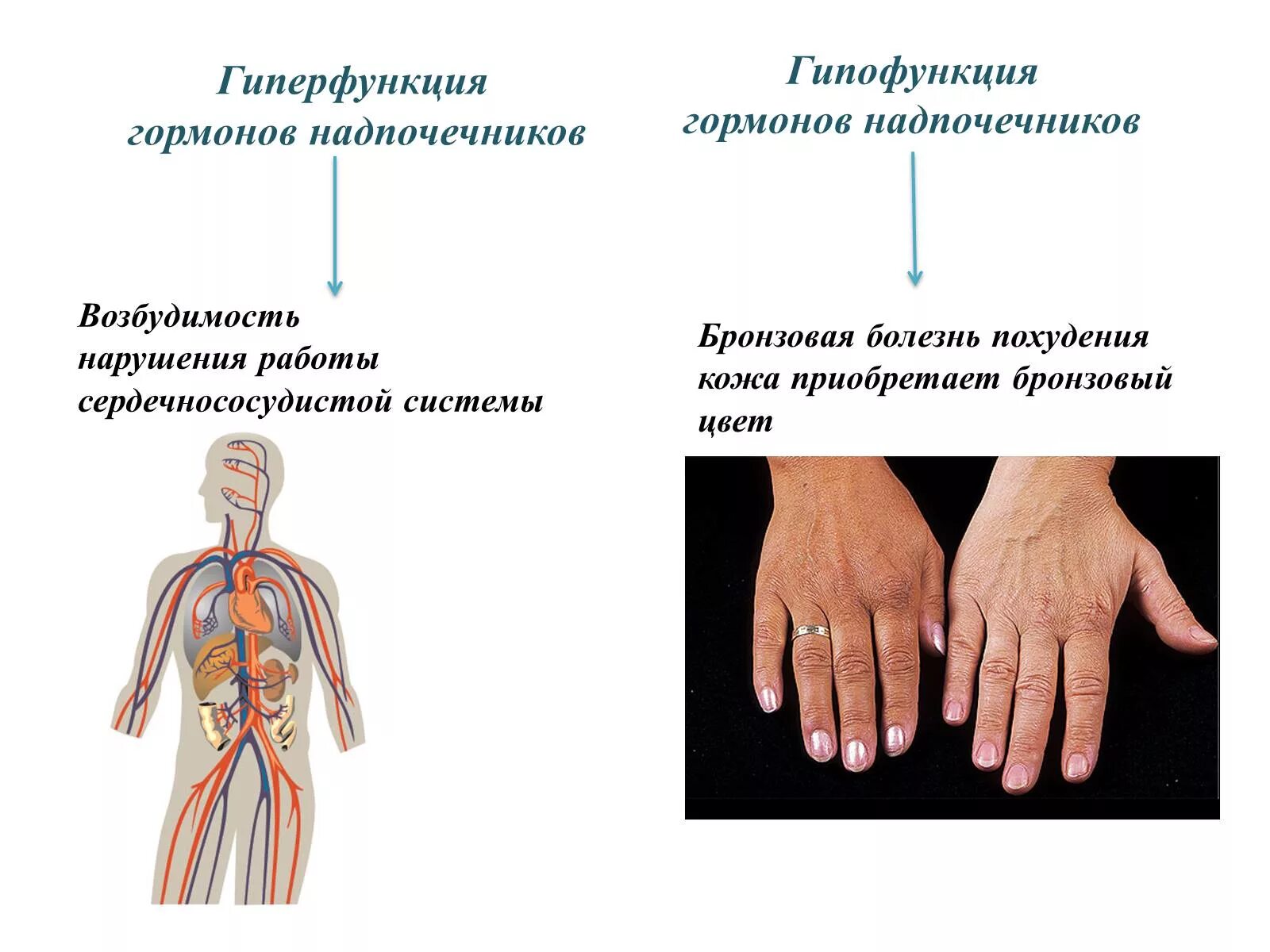 Какие заболевания надпочечников. Надпочечники гормоны гиперфункция и гипофункция. Гиперфункция надпочечников болезни. Гиперфункция мозгового вещества надпочечников болезни. Надпочечники гиперфункция и гипофункция.