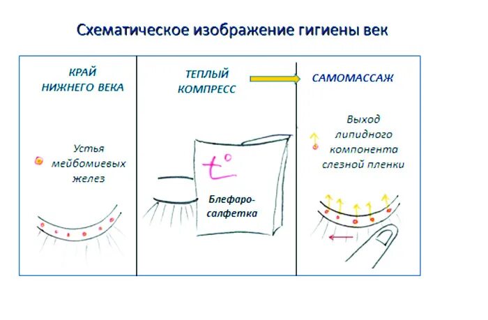Массаж век при блефарите схема. Массаж при блефарите века стеклянной палочкой. Массаж век при блефарите схема. Гигиена век при блефарите. Массаж век глаз при блефарите.