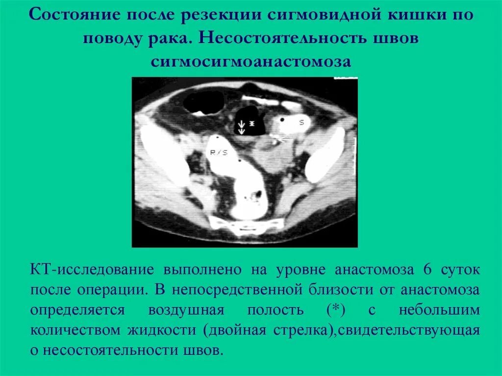 Рак сигмовидной кишки прогноз после операции отзывы. Опухоль сигмовидной кишки на кт. несостоятельность швов анастомоза.
