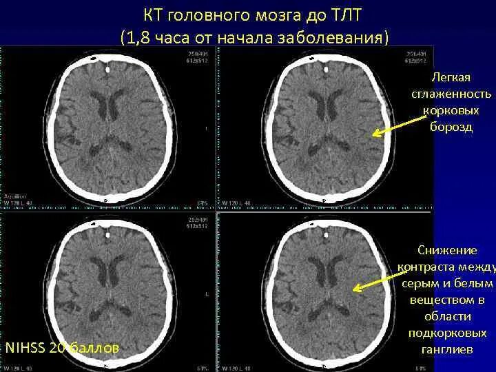 Кортикальный ишемический инсульт мрт. Ишемический инсульт на кт головного мозга. Серое вещество головного мозга на кт. Борозды головного мозга сглажены кт. Поражение белого вещества мозга