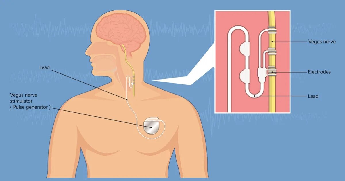 Стимулятор блуждающего нерва. Вагус стимулятор блуждающего нерва. Аппарат для стимуляции блуждающего нерва. Имплантация стимулятора блуждающего нерва. VNS стимулятор.