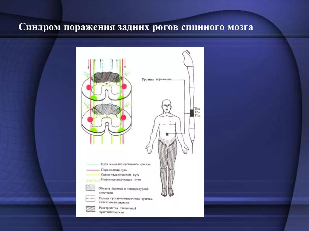 Поражение передних рогов. Симптомы поражения передних Рогов спинного мозга. Синдром заднего рога спинного мозга. Синдром поражения переднего рога спинного мозга. Синдром поражения задних Рогов спинного мозга.