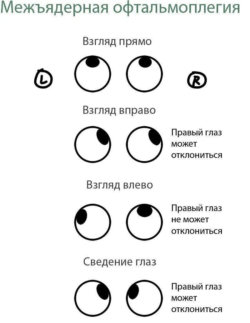 Нарушение движения глаз. Синдром офтальмоплегия (наружная, внутренняя, тотальная). Офтальмоплегия наружная внутренняя тотальная. Офтальмоплегия внутренняя и наружная неврология. Офтальмоплегия (наружная, внутренняя, тотальная) неврология.