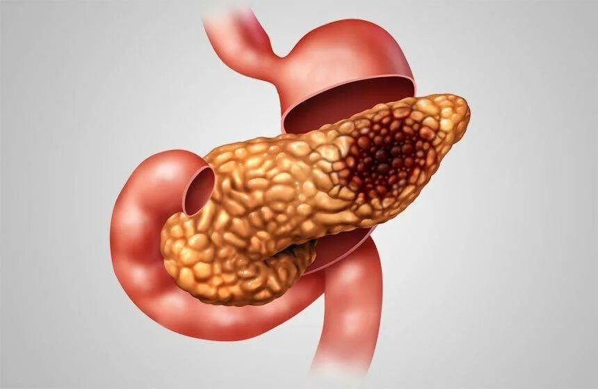 Влияние печени на поджелудочную. Панкреатит поджелудочной железы. Поджелудочная железа острый и хронический панкреатит. Поджелудочная железа алкоголика.