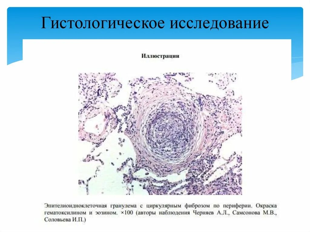 Саркоидная гранулема. Саркоидная гранулема гистология. Туберкулезная гранулема гистология. Туберкулез гистология. Саркоидоз легкого микропрепарат.