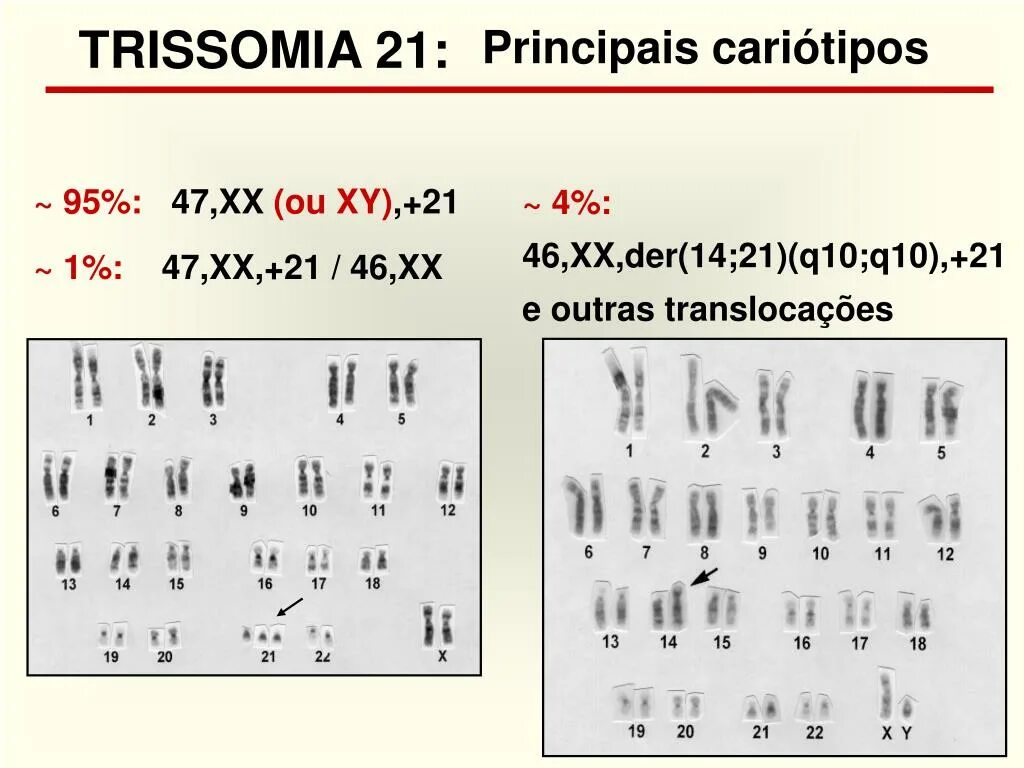 45 ХХ кариотип. Нормальный женский кариотип. Кариотип 47 ХХ +21. Кариотип 46 XY И 46 XX.