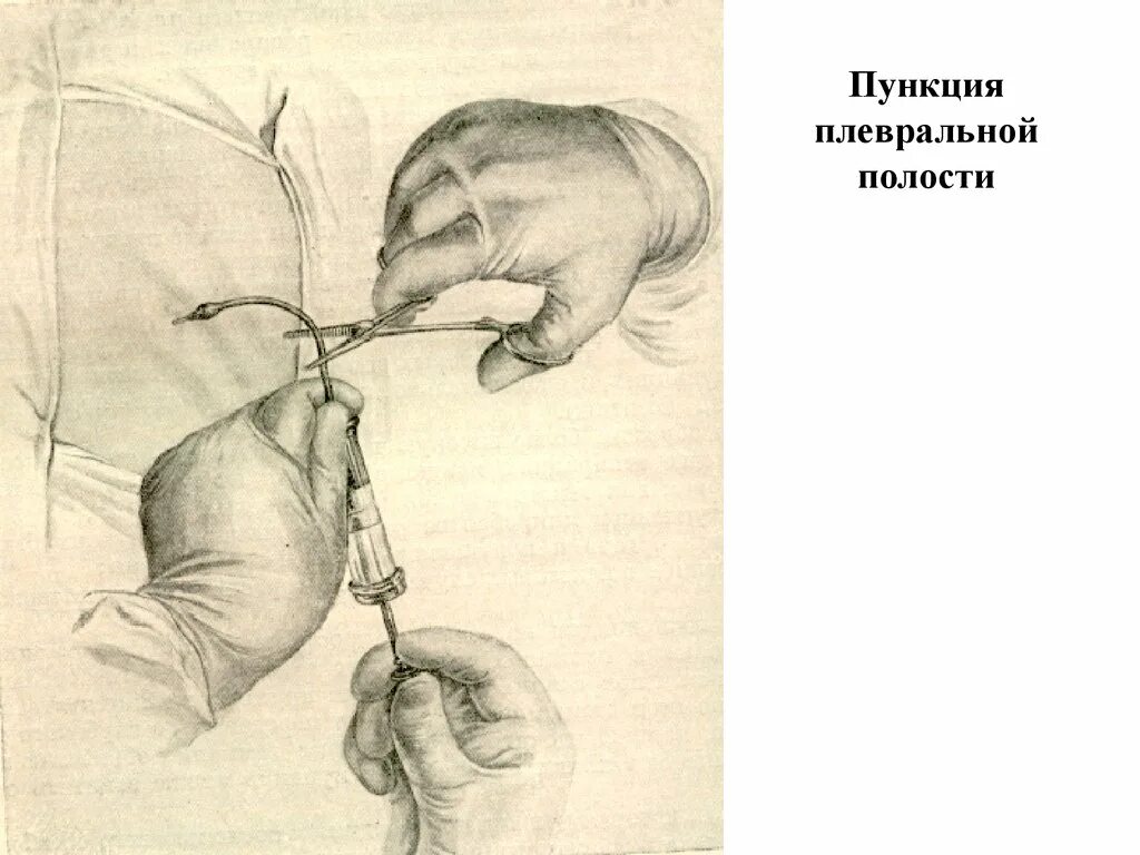 Плевральная пункция торакоцентез. Плевральная пункция (торакоцентез) на животе. Пункция плевральной полости техника.