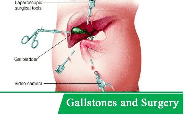 Пиво после удаления желчного. Лапароскопия камней желчного пузыря. Операция лапароскопическая холецистэктомия. Операции лапароскопия холецистэктомия. Лапароскопическая операция на желчном пузыре.