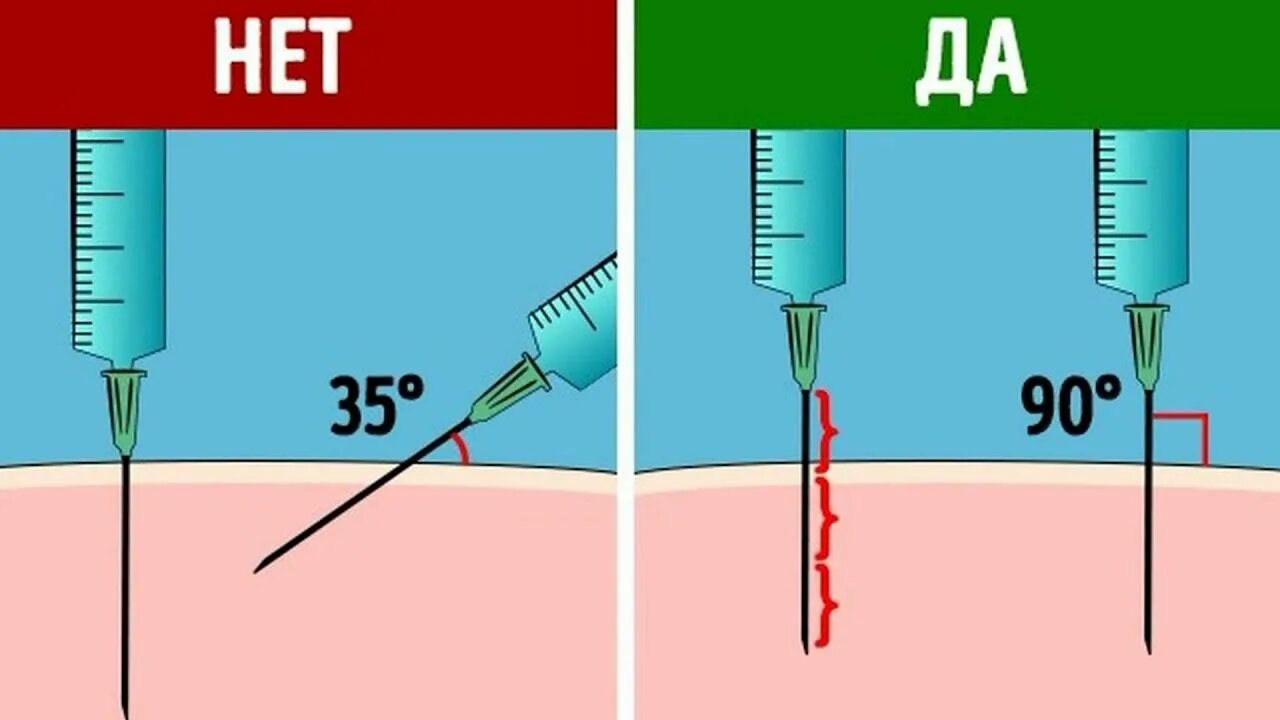 Куда и насколько. Как делать укол внутримышечно в ягодицу. Как правильно делать уколы внутримышечно в ягодицу. Как правильно делать уколы внутримышечно в ягодицу домашних условиях. Как колоть внутримышечные уколы в ягодицу.