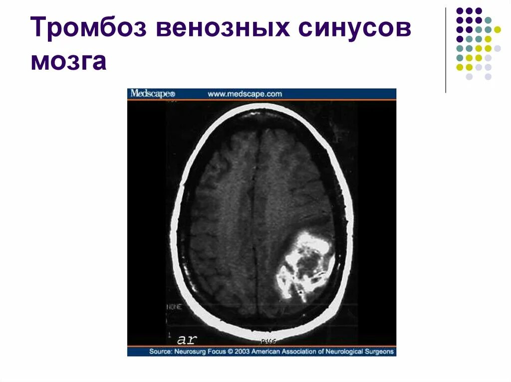 Тромбоз кавернозного синуса на кт. Тромбоз сигмовидного синуса на кт. Тромбоз пещеристого синуса кт. Тромбоз сагиттального синуса на кт. Церебрального тромбоза