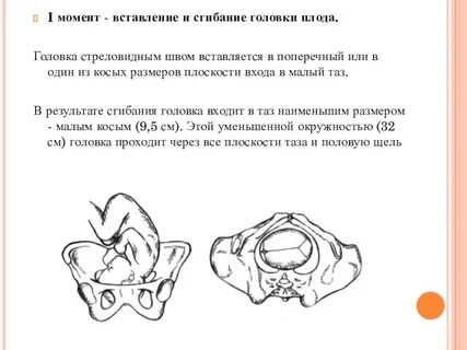 Стреловидный шов в поперечном размере