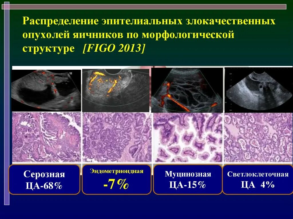 Злокачественные опухоли яичников. Эпителиальная опухоль яичника. Доброкачественные эпителиальные опухоли яичников. Эпителиальная опухоли яичникоа. Серозная пограничная опухоль