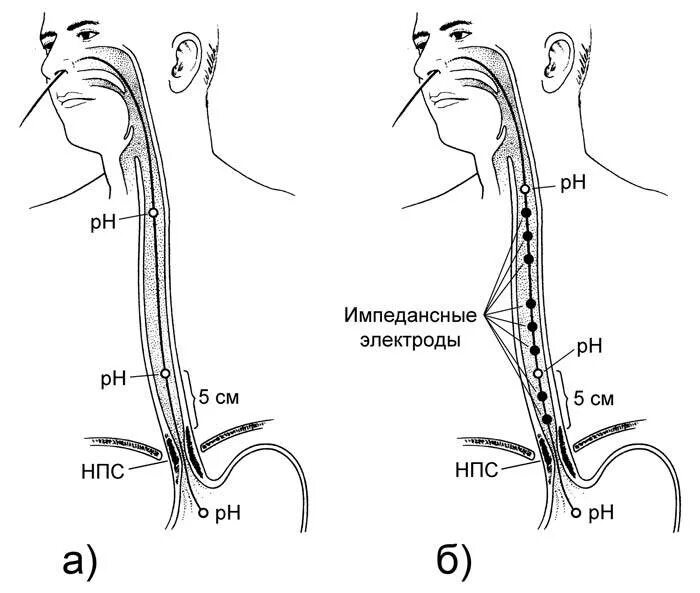 Нижний пищевод. 24 Часовая PH импедансометрия пищевода. РН метрия пищевода зонд. Суточная РН импедансометрия пищевода. Импеданс-РН-метрия пищевода.