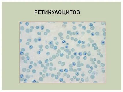 Ретикулоцитоз