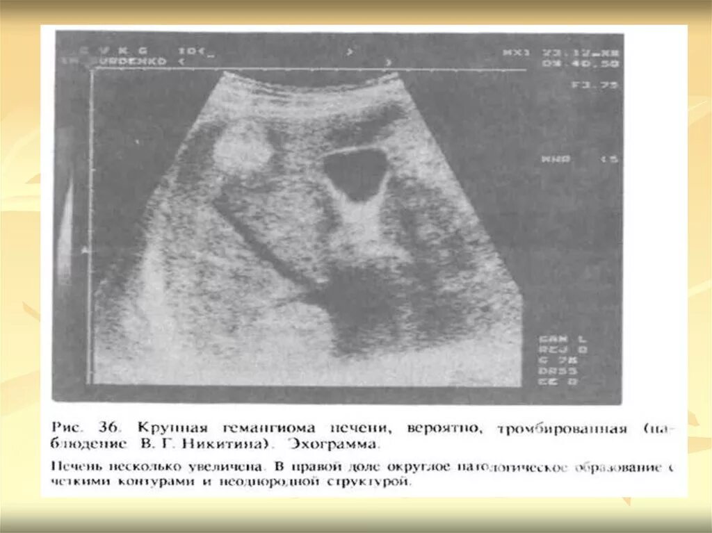 Образование неоднородной структуры в печени. Неоднородная структура печени на узи. желчь неоднородной структуры на узи. узи надпочечников на узи.