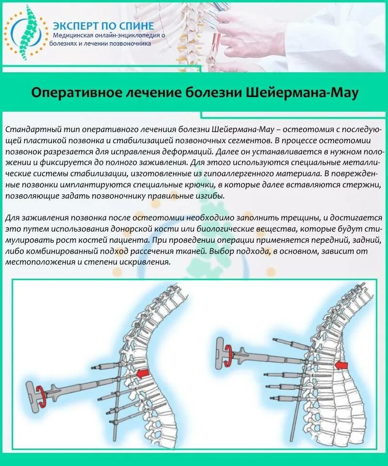 - Гиперкифоз (болезнь Шейермана-МАУ). Болезнь Шейермана МАУ корсет Шено. Операция при болезни Шейермана МАУ. Болезнь Шерман МАУ позвоночника.