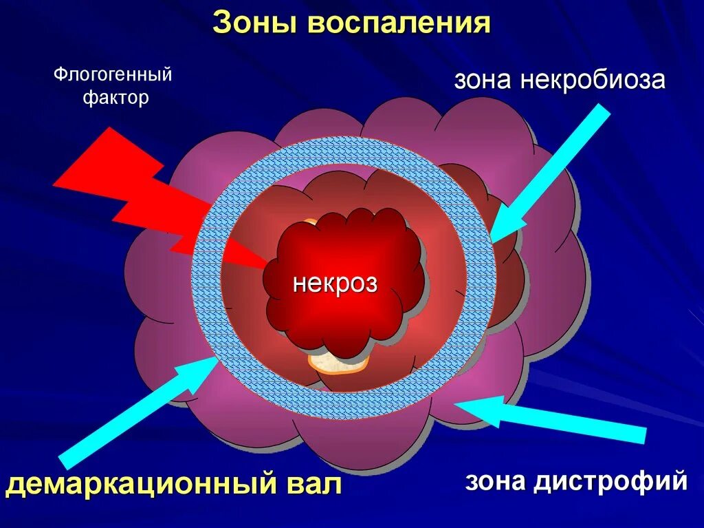 Чем грозит воспаление. Зона демаркационного воспаления.