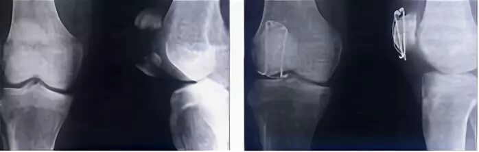 Перелом надколенника операции. Хондральный перелом надколенника. Краевой перелом надколенника. Вывих надколенника рентген. Перелом надколенника остеосинтез.