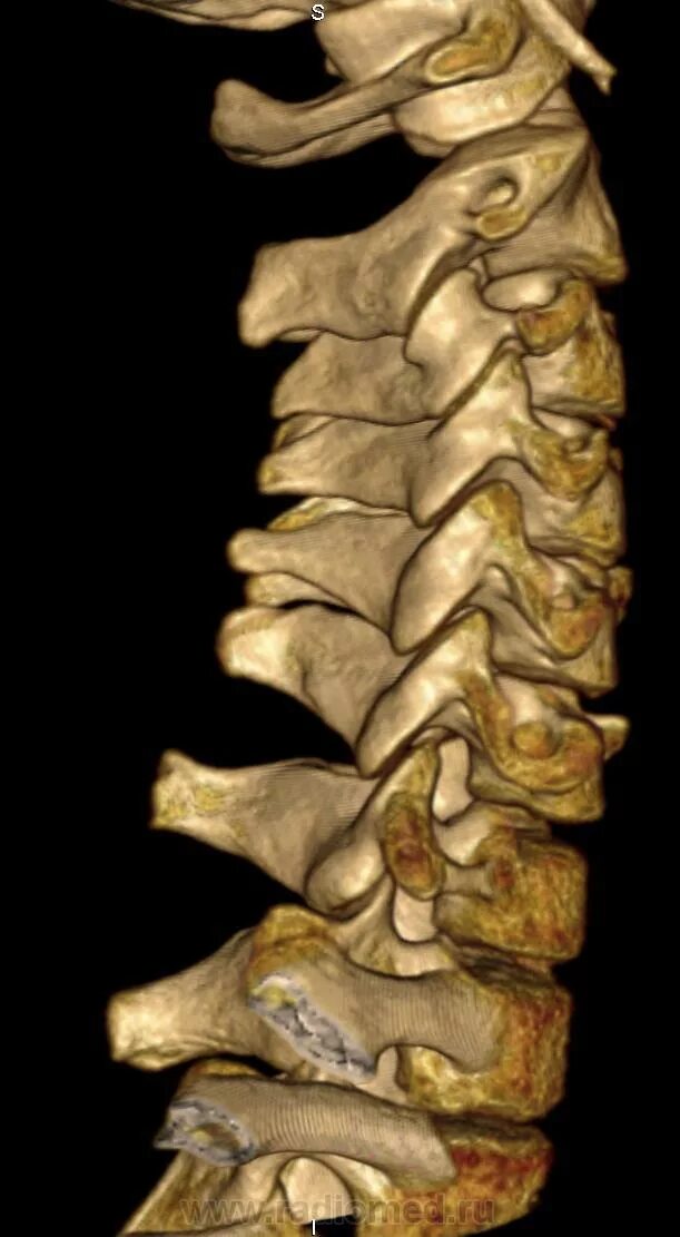 Конкресценция позвонков на кт. Конкресценция шейных позвонков. Аномалии развития 2 шейного позвонка. Пороки развития позвоночника.