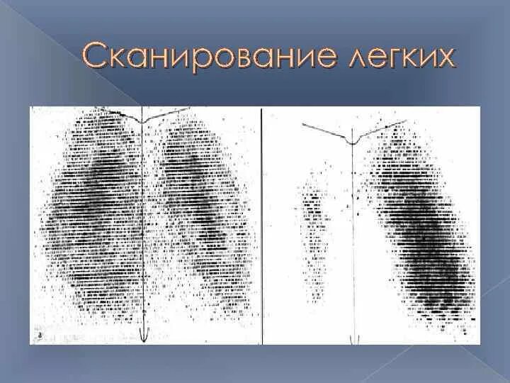 Сканирование легких. Сканер легких. первые сканограммы легких. результаты сканирования лёгких.