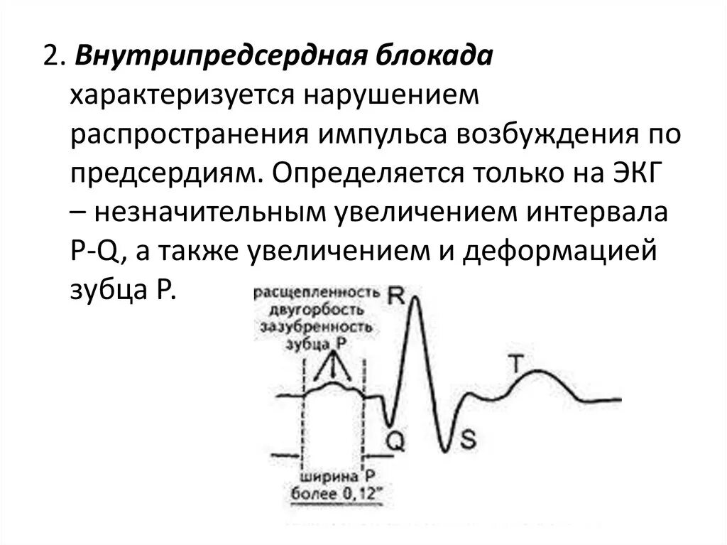 Что значит внутрипредсердная внутрипредсердная блокада. Признаки замедления внутрипредсердной проводимости на ЭКГ. Нарушение внутрипредсердного проведения на ЭКГ. ЭКГ признаки внутрипредсердной блокады 1 степени. Внутрипредсердная блокада 2 степени на ЭКГ.