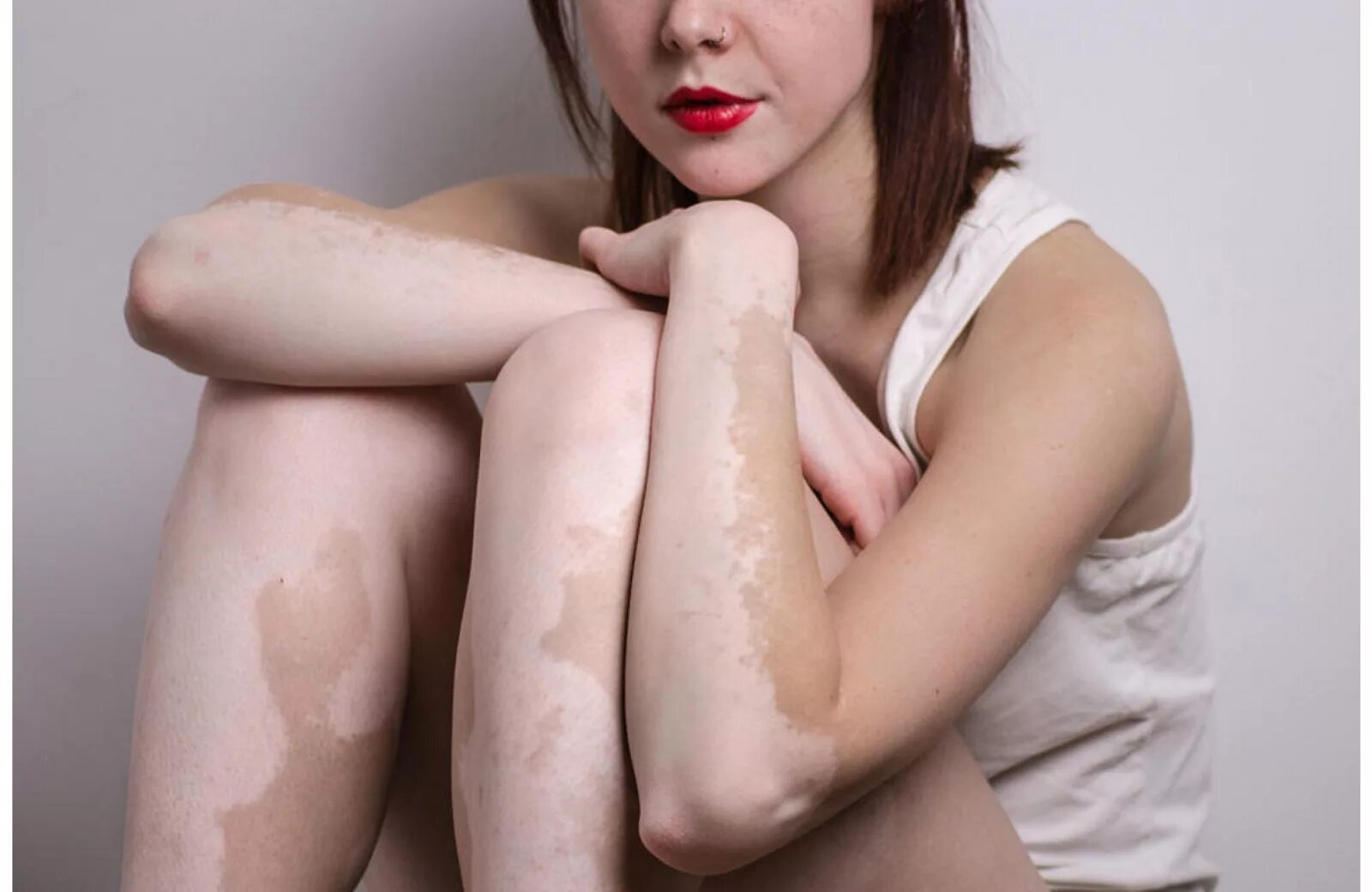 бледная кожа болезнь