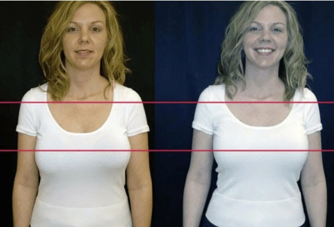 Разная по размеру грудь. Правильная посадкабюстгалтера. Грудь разного размера. Нормальная грудь. Почему у девушек разные размеры.